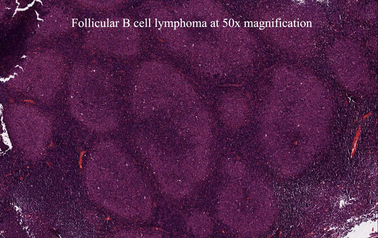 follicular B cell lymphoma at 50x magnification